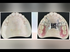 Removable Denture Cobalt Chrome Bracket Removable Dental Crown  Durable