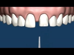 Co-CR MK1 Präzisions-Zubehör-Gebiss-Korrosionsbeständigkeit