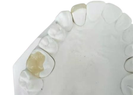 Dauerhafte flexible PFM-Brücken-Krone zahnmedizinische IPS E Max Press Inlay Onlay