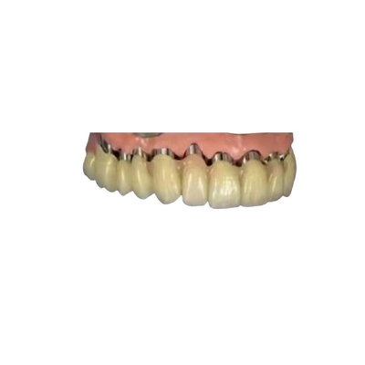 Implantats-Kronen-Brücken-teleskopische Krone zahnmedizinisches 3D CAD-Nockens PFM druckte Modelle