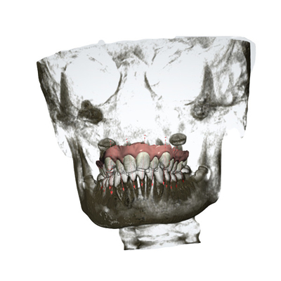 Schneller palataler Expander genaues entfernbares orthodontisches Gerät-Soems