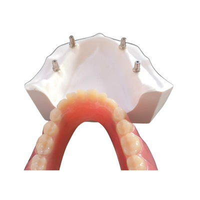 Bequemer Zahnimplantat einfaches Overdenture CAD-Nockens halten instand