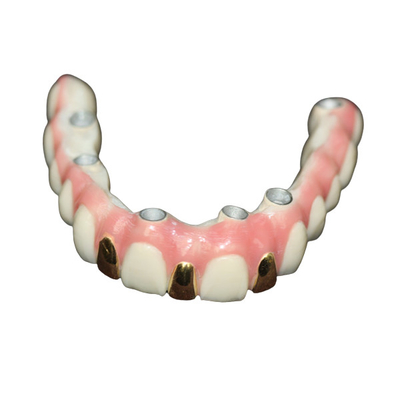 Präzision Digital 3D, die das Zahnimplantat-Stangen-Metall basiert druckt
