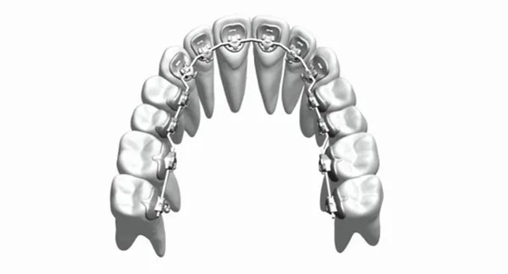 Gewohnheits-richten örtlich festgelegte orthodontische Geräteklammern Zahn-Edelstahl Bioceramic gerade