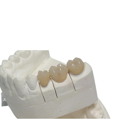 Vorübergehende zahnmedizinische Krone 3D CAD/Nockens PFM, die Entwurfs-Gebiss-Kundenbezogenheit druckt