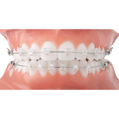 Einfache saubere orthodontische keramische Klammer-schöne örtlich festgelegte orthodontische Geräte