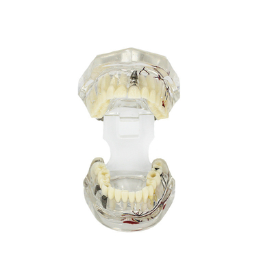 Transparentes pathologisches Zahnmodell Dental mit Zahnnervenanpassung