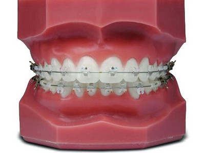 Bequeme festsitzende kieferorthopädische Geräte Schöne natürliche Keramikbrackets