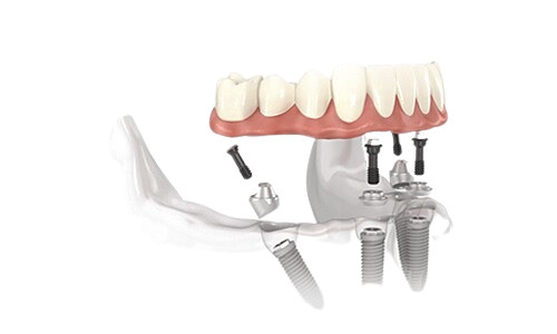 Unsichtbare herausnehmbare Prothesen Gefüllte Implantate Vollständige Wiederherstellung Deckprothese