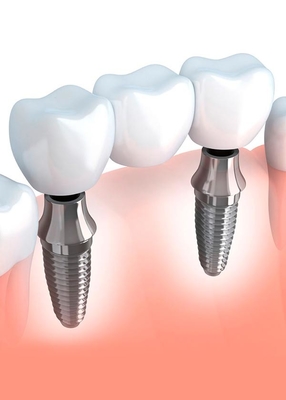 OEM Dental Crown Bridge Good Biocompatibility Smooth Surface Make Smile Sweeter