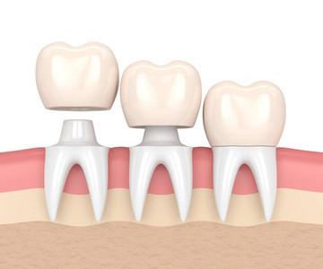 Farbstabile Farbe Porcelai CrownRealistic nicht einfach, Porzellan zu brechen