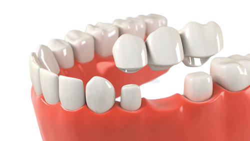 OEM Dental Crown Bridge Good Biocompatibility Smooth Surface Make Smile Sweeter