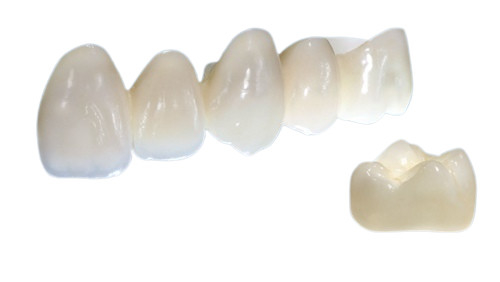 Porzellan-Kronen sind in der Stabilität schönes in Form lebensechtes in der Farbe und stark