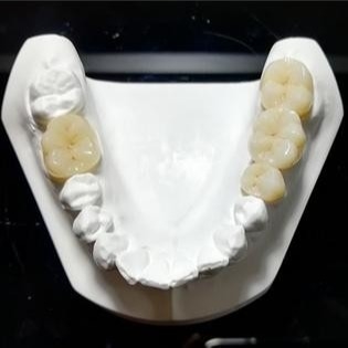 Standhafte Qualität die Mark Of Our Ceramic Dental-Kronen
