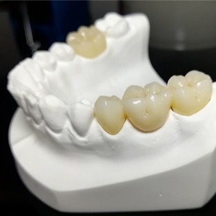 Standhafte Qualität die Mark Of Our Ceramic Dental-Kronen