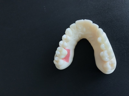 Digitales Oralscanning von PFM-Zahnkronen überbrückt die Anforderungen der Implantologie