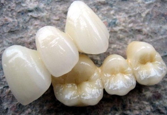Hohes Kronen-Porzellan Biocompatibility PFM fixiert für Backenzahn-Wiederherstellung