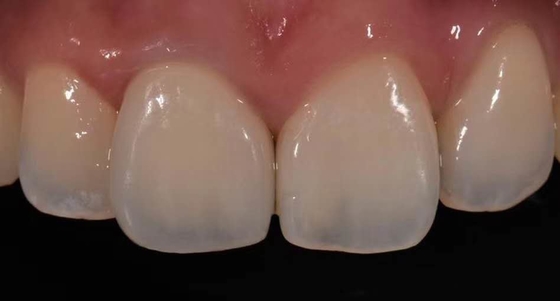 Hohes Kronen-Porzellan Biocompatibility PFM fixiert für Backenzahn-Wiederherstellung