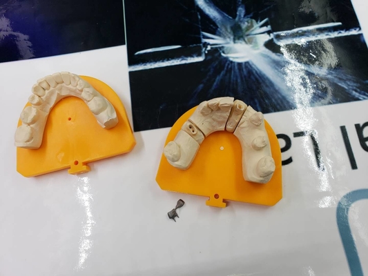 Volle zahnmedizinische Kronen-Brücken-High-Teches biologisches Material des Metallpfm