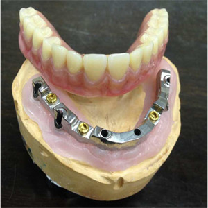 Hohes biologisches Inter- Missbarkeits-Gebiss-zahnmedizinisches Laborsicherheits-Implantat