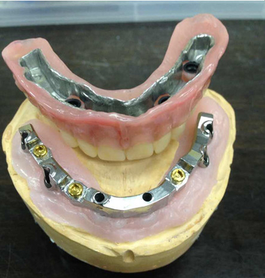 Hohes biologisches Inter- Missbarkeits-Gebiss-zahnmedizinisches Laborsicherheits-Implantat