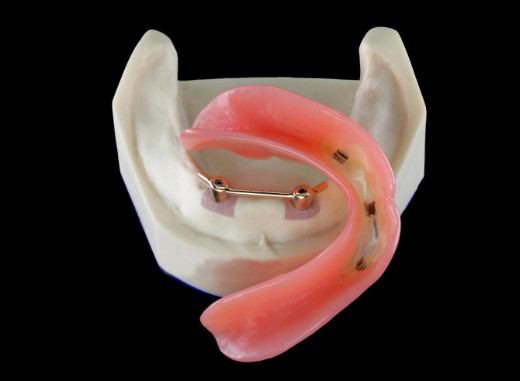 Sicherte Titan-Implantat CNC-All-On-4 Gebisse für zahnmedizinische Klinik