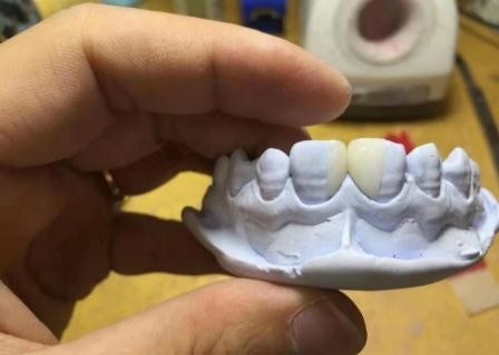 Kronen-Gesundheits-Materialien des leistungsfähigen Harz-entfernbare PFM zahnmedizinische