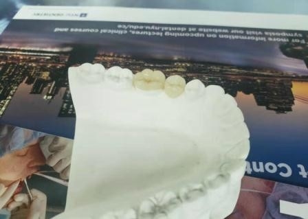 Dauerhafte flexible PFM-Brücken-Krone zahnmedizinische IPS E Max Press Inlay Onlay