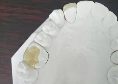 Dauerhafte flexible PFM-Brücken-Krone zahnmedizinische IPS E Max Press Inlay Onlay