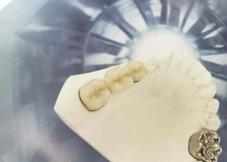 Soempolierporzellan-zahnmedizinische Krone hohes biologisches Intermiscibility