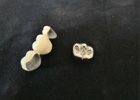 Soempolierporzellan-zahnmedizinische Krone hohes biologisches Intermiscibility