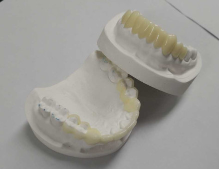 Hohe Haltbarkeit CAD CAM 3D-Druck Temporäre Kronen Langlebiges Harz
