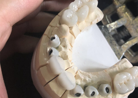 Metallfreies weißes Zirkoniumdioxid-zahnmedizinische Kronen ausgezeichnetes Biocompatibility