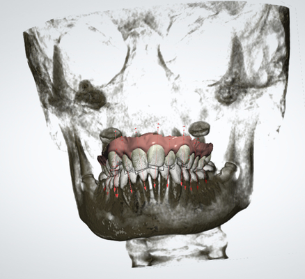 Schneller palataler Expander genaues entfernbares orthodontisches Gerät-Soems