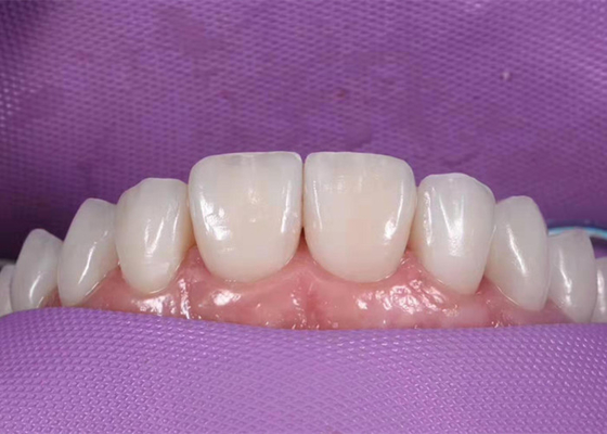 0.3MM weiß werdene keramische zahnmedizinische Krone, zum von ungesunden Zähnen zu ersetzen