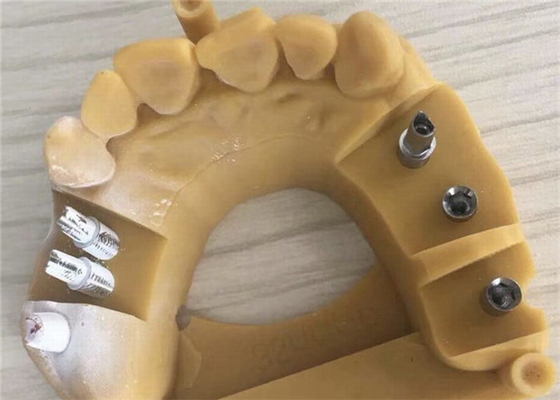 Zahnmedizinische Krone 3D Digital Biocompatibility PFM, die vorübergehende Kronen druckt