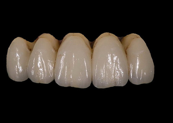 Einfach behalten Sie orthodontisches PFM-Porzellan-zahnmedizinische Kronen-Farbechtheit bei