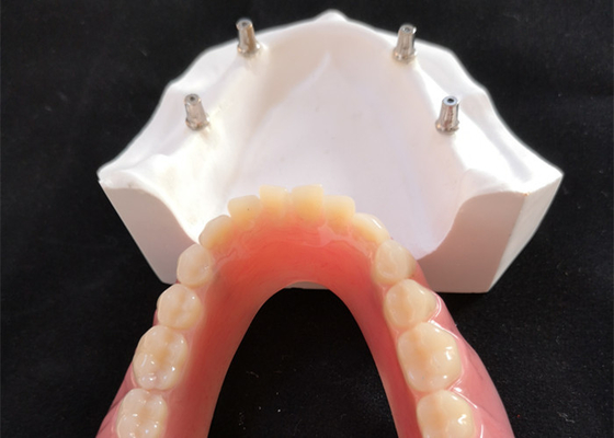 Bequemer Zahnimplantat einfaches Overdenture CAD-Nockens halten instand