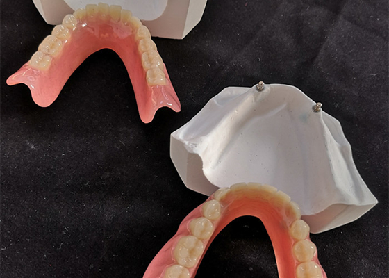 Bequemer Zahnimplantat einfaches Overdenture CAD-Nockens halten instand
