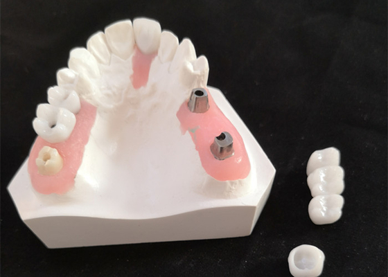 FDA Zirkonie-Krone mit Implantat-gestützten Zahnersatz für Zahnarztlabor