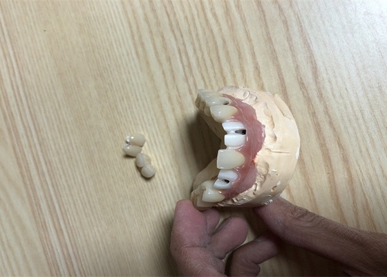 Genaue Zahnimplantat-Zubehör-Zahn-Implantats-Krone Biocompatibility