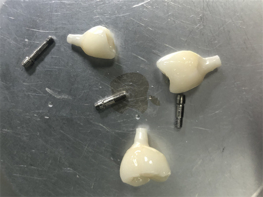 Zirkonia-Implantat-Restaurierung Keine Farbprobleme