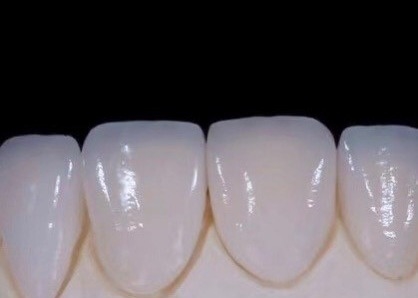 EMAX Haltbarkeit CAD/CAM Dental Composite Veneers Hoch detailliert Genau