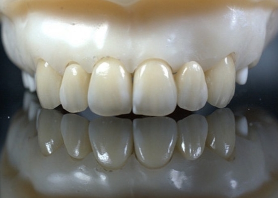 EMAX Haltbarkeit CAD/CAM Dental Composite Veneers Hoch detailliert Genau