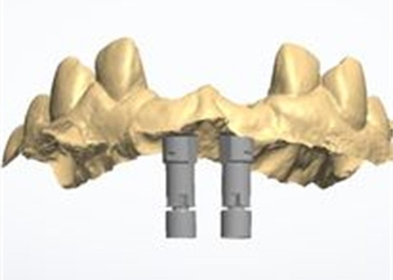 Präzise CAD/CAM-Konstruktion Zirkonia Zahnkrone für die Anpassung