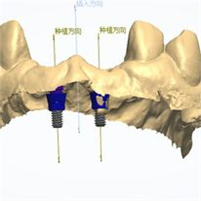 Präzise CAD/CAM-Konstruktion Zirkonia Zahnkrone für die Anpassung