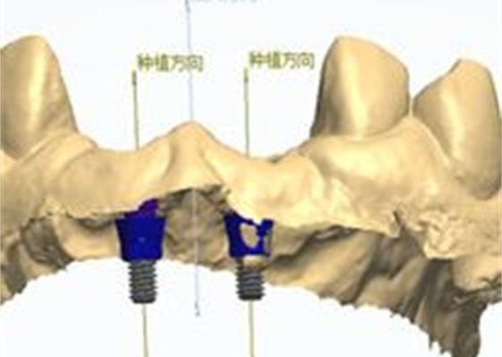 3D-Modell Zirkonia-Krone