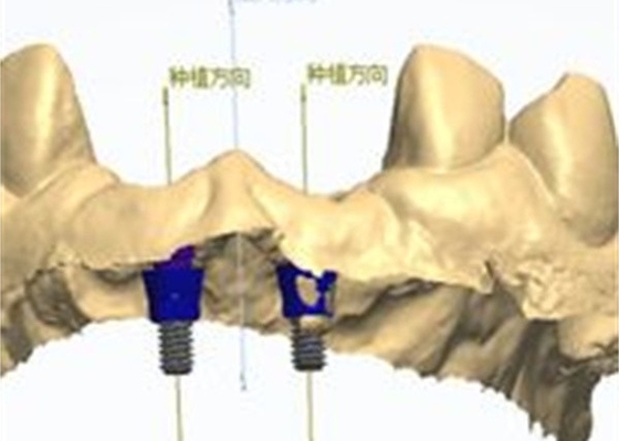 Präzise CAD/CAM-Konstruktion Zirkonia Zahnkrone für die Anpassung