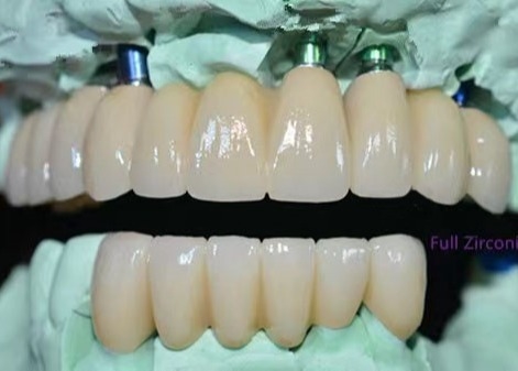 OEM Implantat Zirkonia Zahnkrone Festbrücke