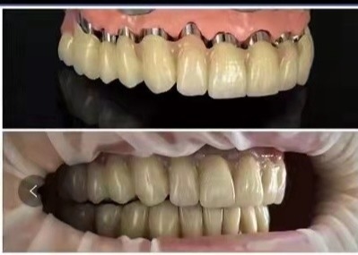 Implantats-Kronen-Brücken-teleskopische Krone zahnmedizinisches 3D CAD-Nockens PFM druckte Modelle